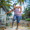 STAND’s work helps amputees like and Rose by providing prosthetic legs and rehabilitation.
