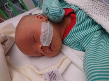 02. At just two days old, Jack underwent an operation to repair his intestine