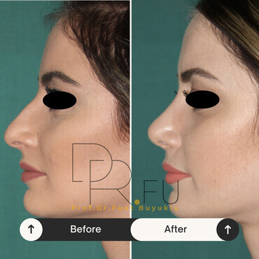 Before After of a patient after sucessful rhinoplasty surgery