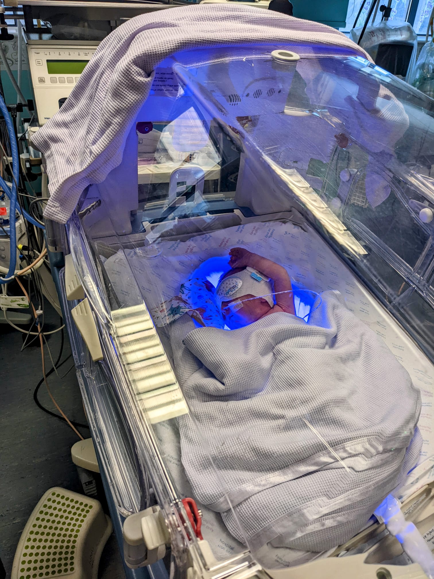 phototherapy for premature babies